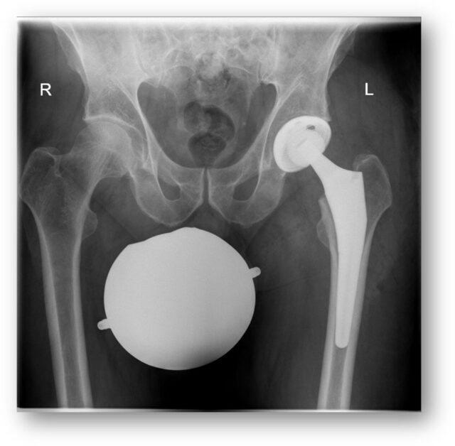 Beitragsbild für diese Veranstaltung moderne-hueft-und-knie-endoprothetik-endlich-wieder-schmerzfrei-und-mobil