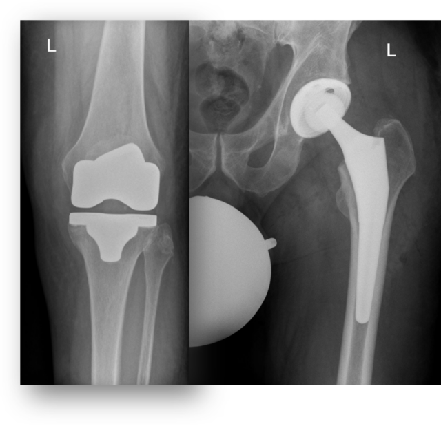 Beitragsbild für diese Veranstaltung moderne-hueft-und-knie-endoprothetik-endlich-wieder-schmerzfrei-und-mobil